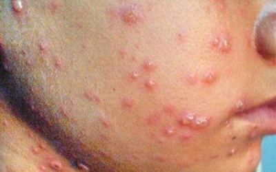 Chồng nhiễm thủy đậu có cần cách ly vợ đang mang thai?